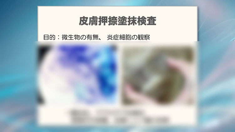 皮膚押捺塗抹検査