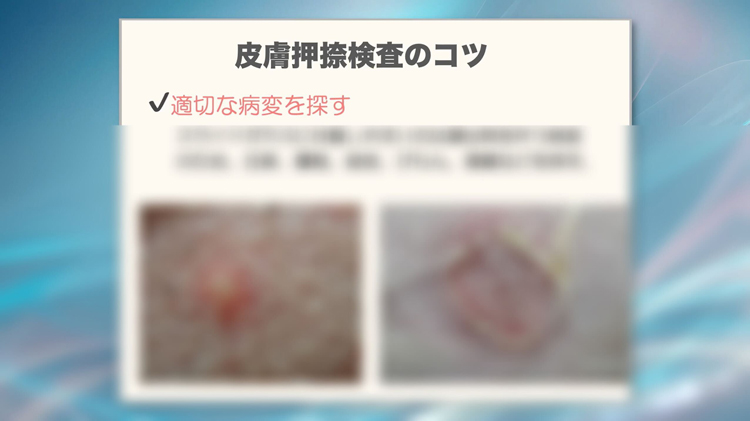 皮膚押捺塗抹検査