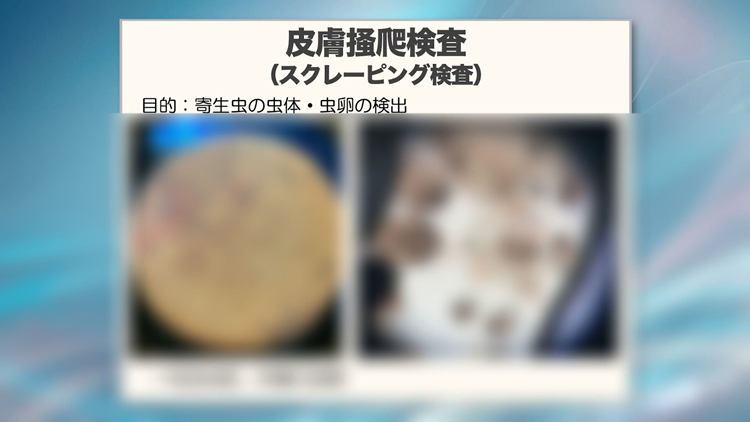 皮膚掻爬検査