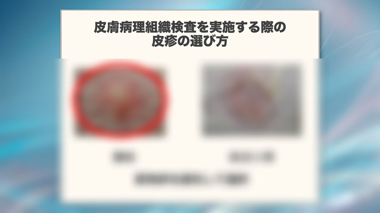 皮膚病理組織検査