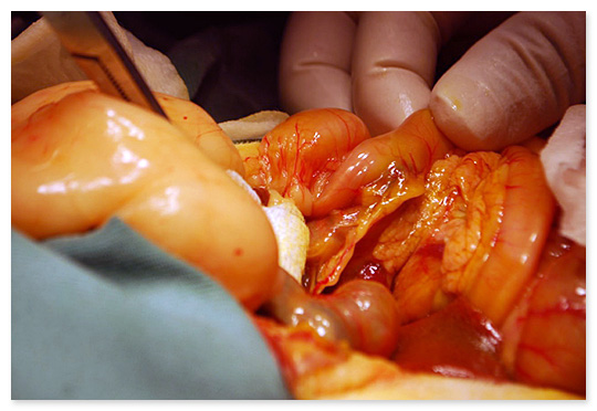 総胆管結石の手術画像…胆管の著しい拡張、十二指腸開口部に結石が閉塞