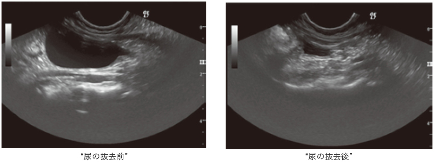 尿の抜去前後の膀胱エコー画像
