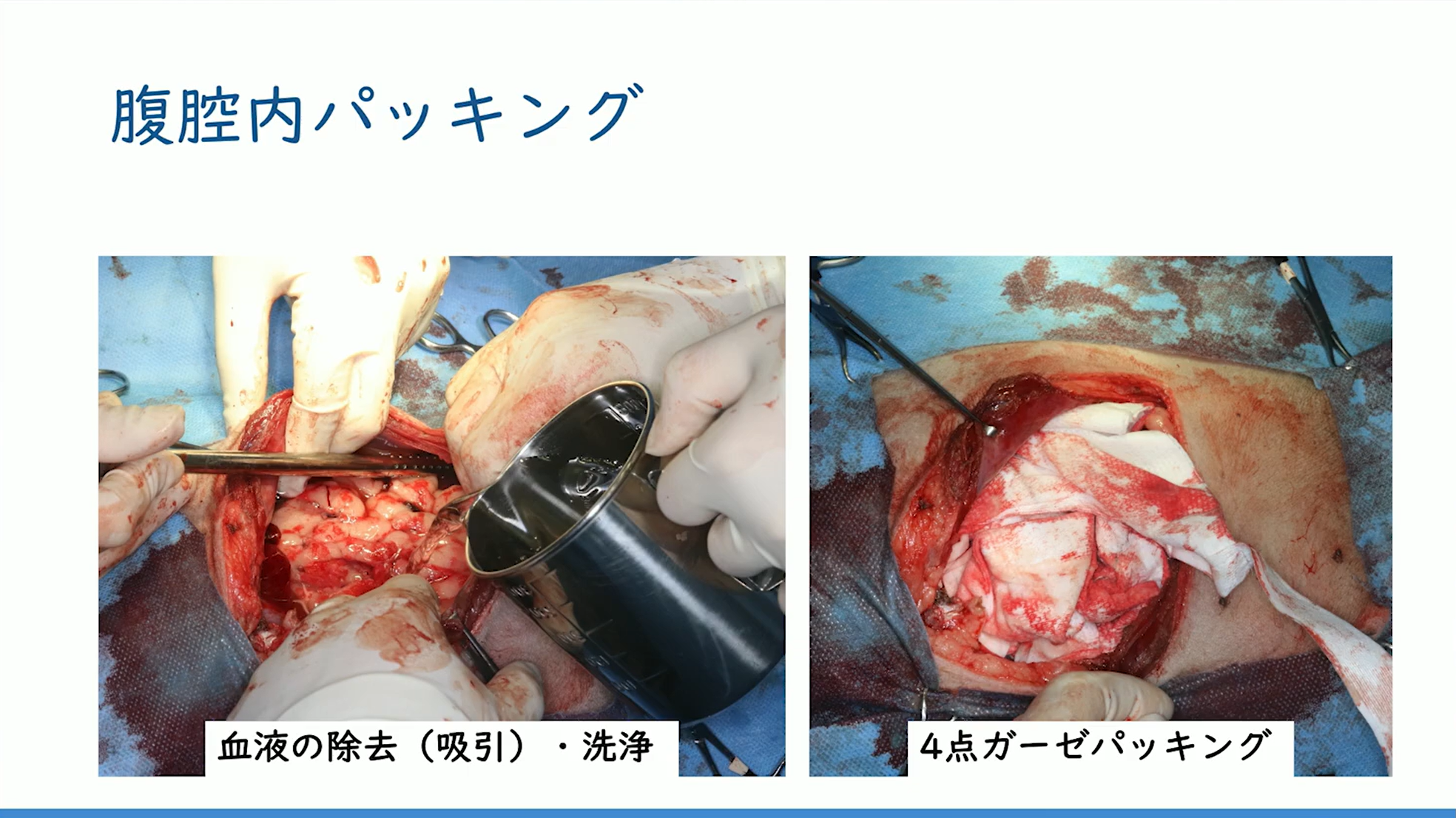 腹腔内パッキング