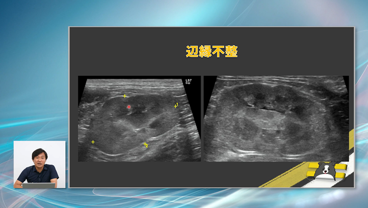 腎盂腎炎は症状が明確でないため、腎エコーがとくに重要です