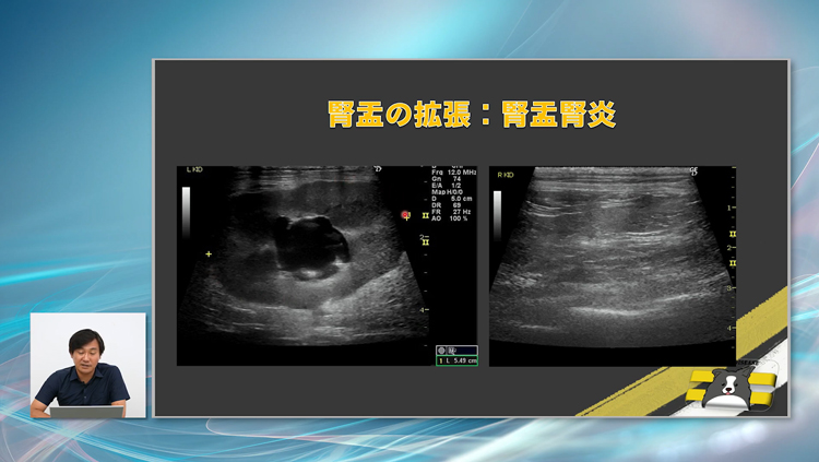 腎盂腎炎は症状が明確でないため、腎エコーがとくに重要です