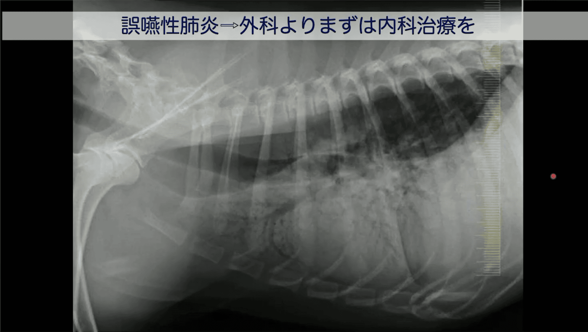 誤嚥性肺炎 外科よりまずは内科治療を