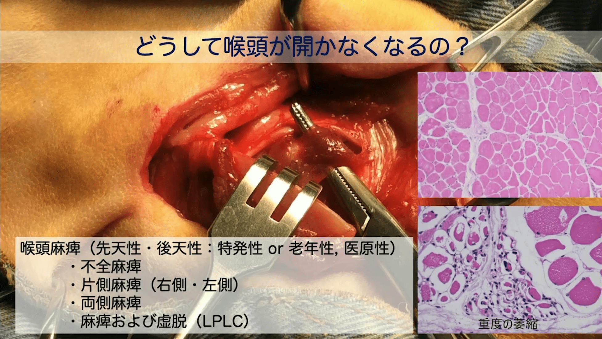 どうして喉頭が開かなくなるの？