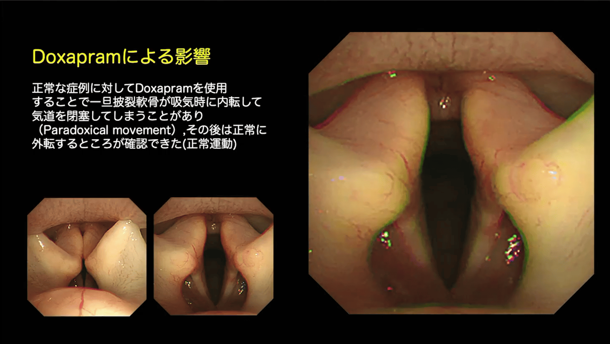 Doxapramによる影響