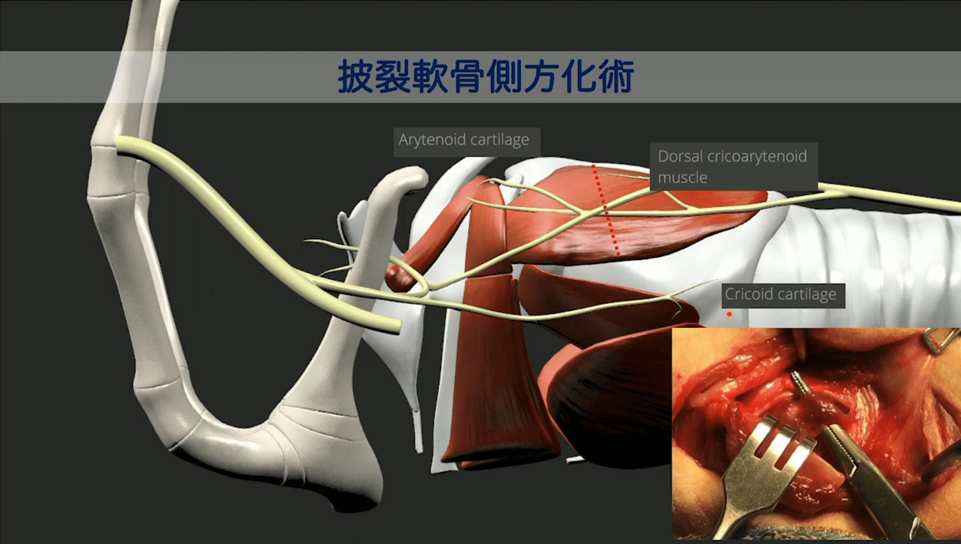 披裂軟骨側方化術