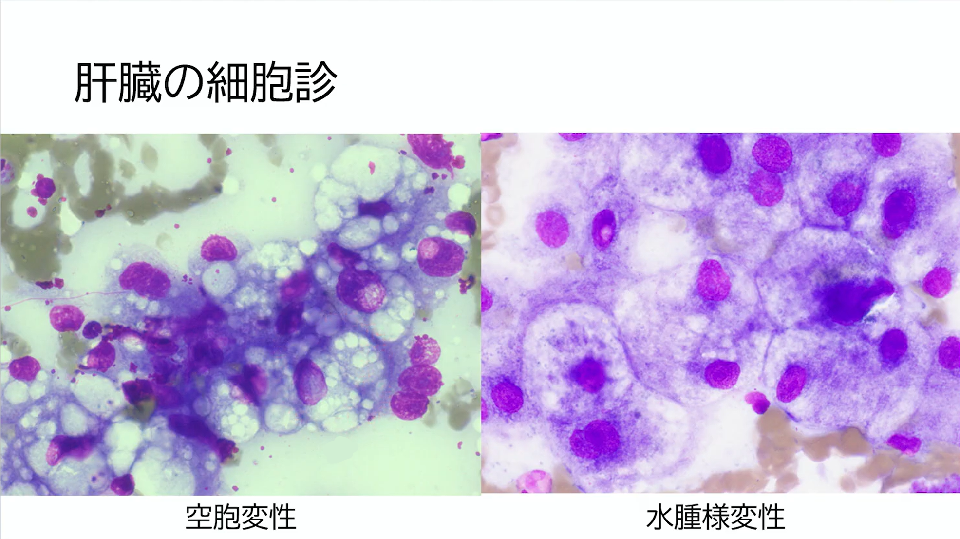 肝臓の細胞診