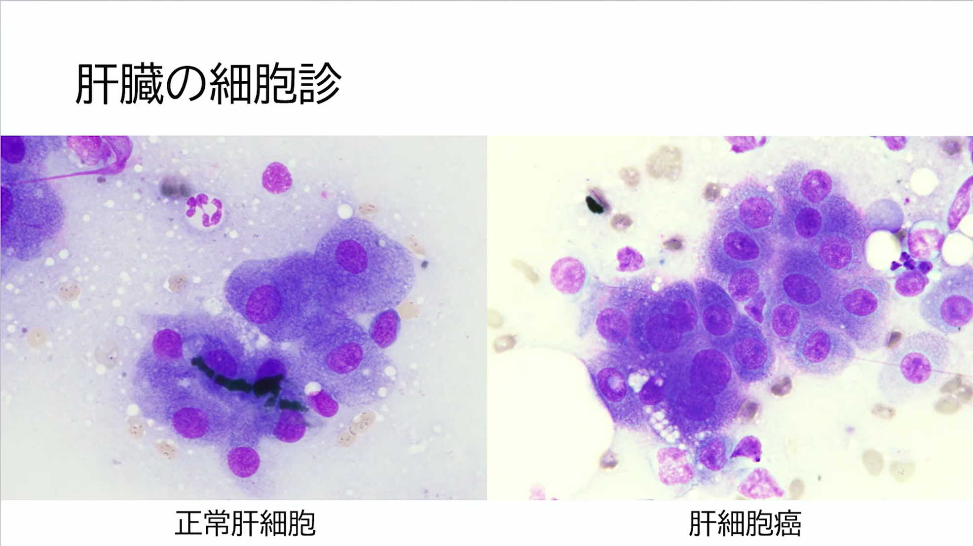 肝臓の細胞診