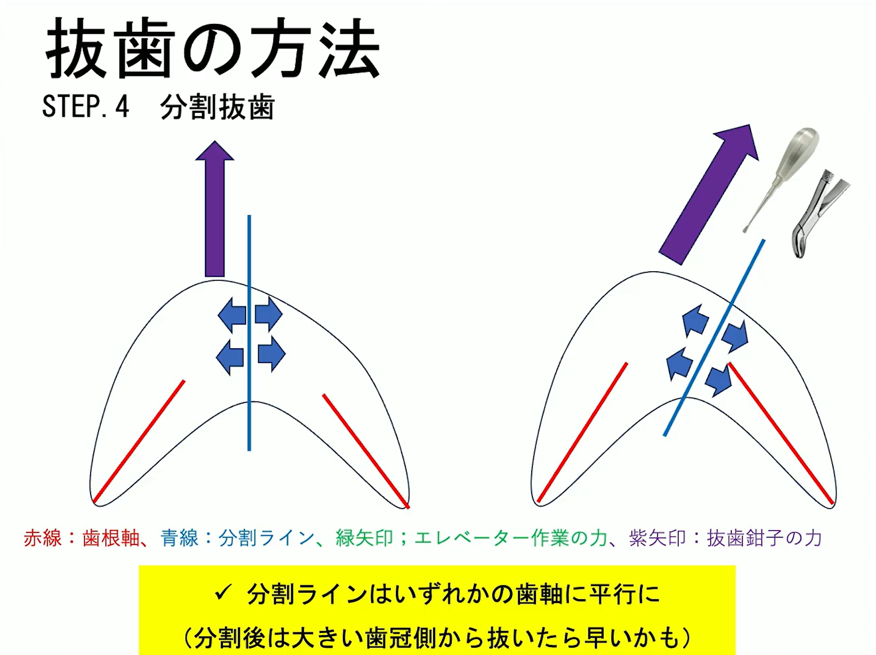 抜歯の方法