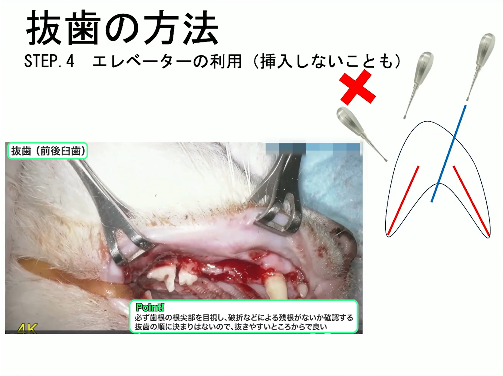 抜歯の方法