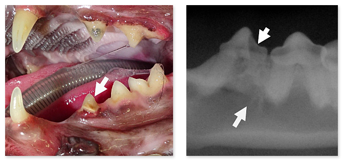 歯冠部が歯髄に及んでおり、歯根膜が消失