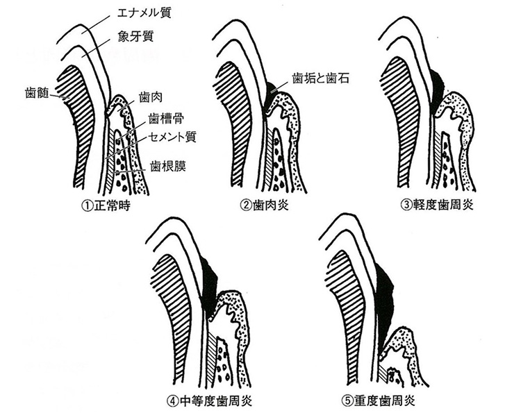 歯周病がどのように進行するのか、詳しくご説明します